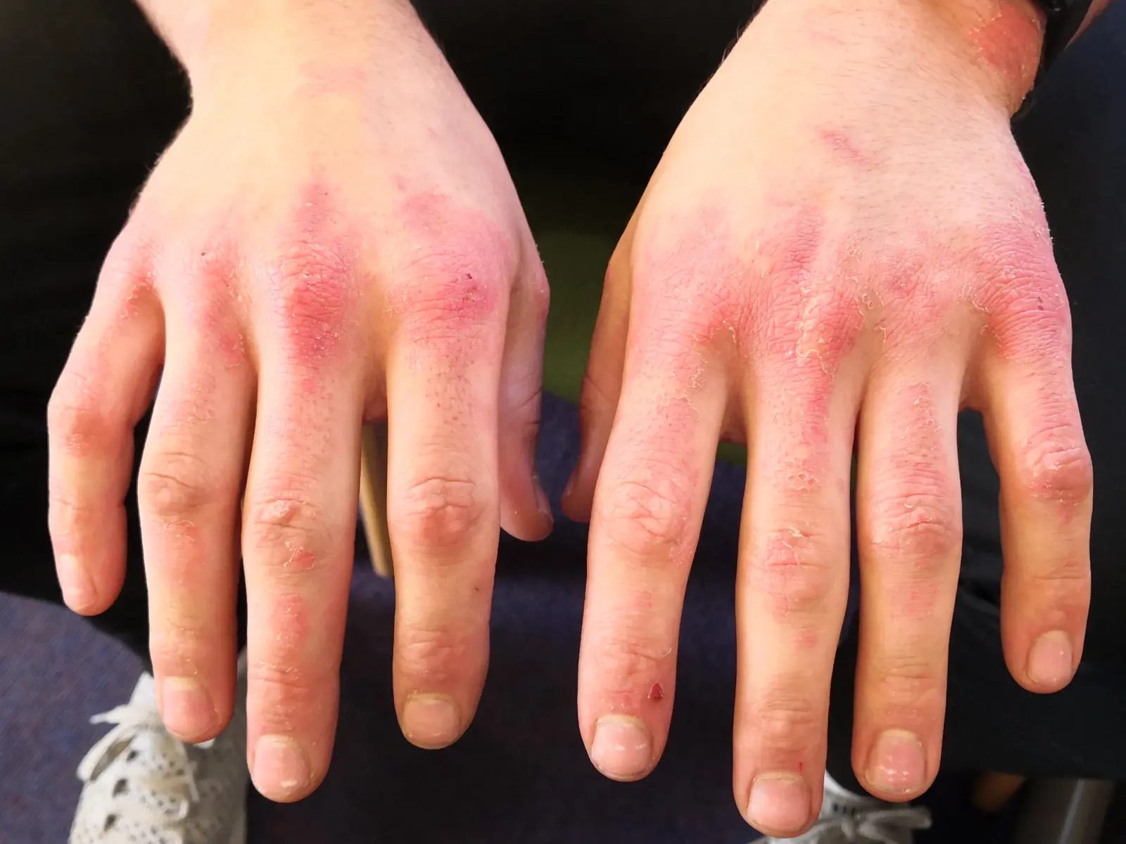 Image of skin on the hands before PBM Therapy