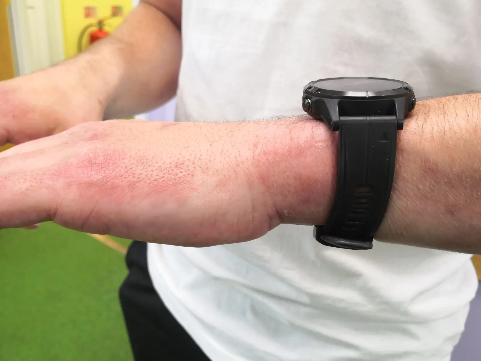 Image of skin on the wrist after PBM Therapy