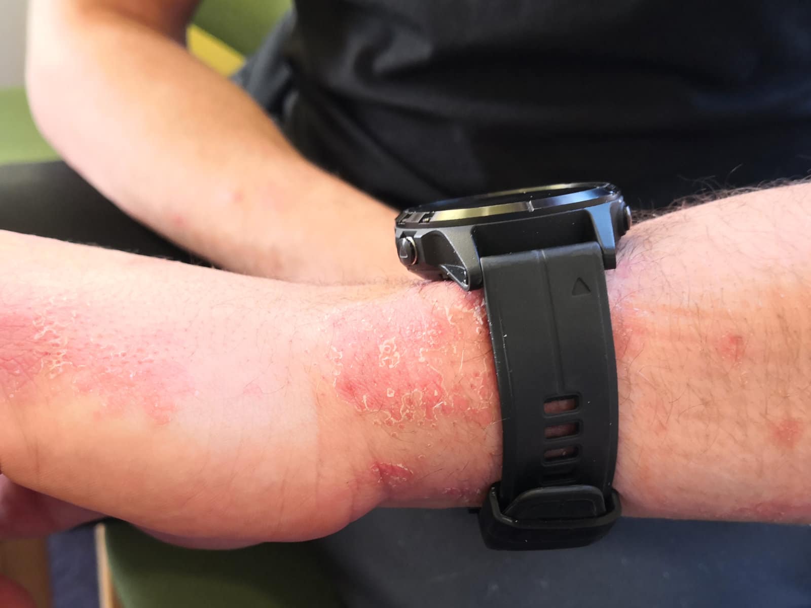 Image of skin on the wrist before PBM Therapy