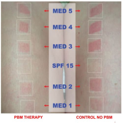 PBM Therapy Prevents UV Skin Damage