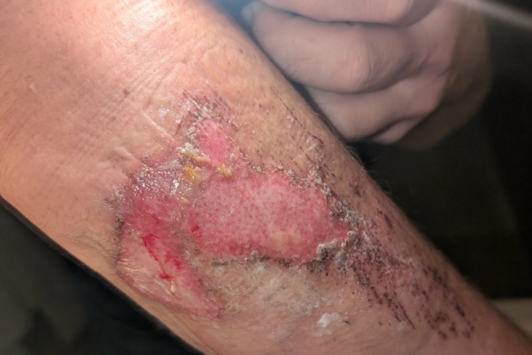 Skin before PBM Therapy