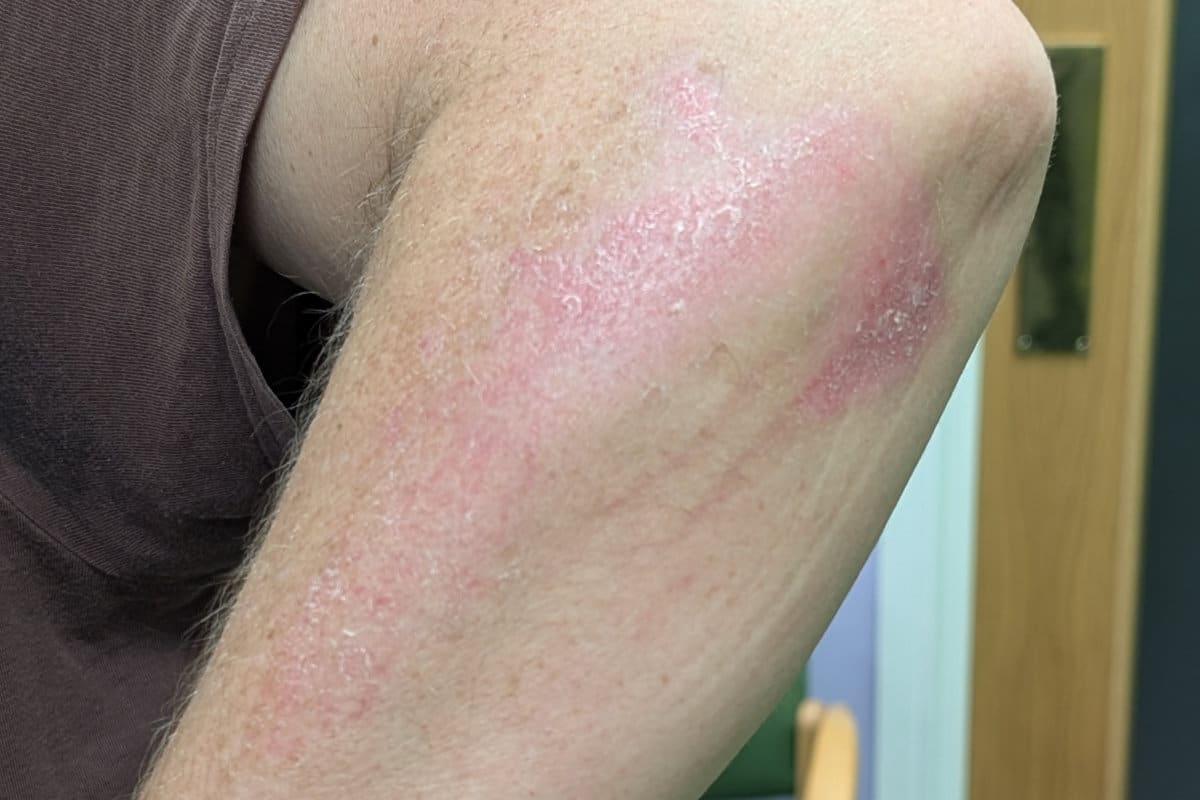 Skin healing after PBM Therapy